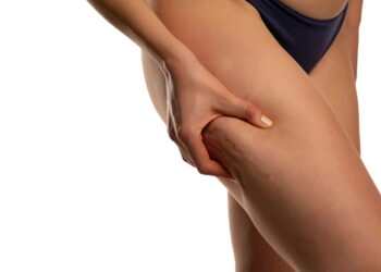 Allenarsi contro la cellulite: da dove iniziare